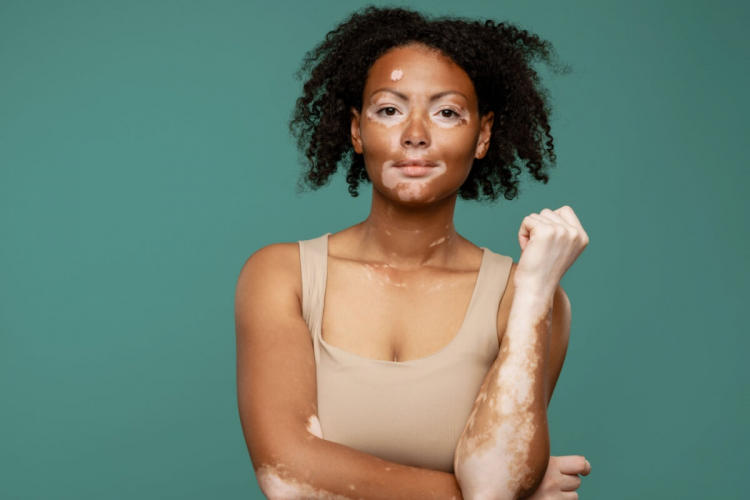 Entenda as causas e os tratamentos para o vitiligo